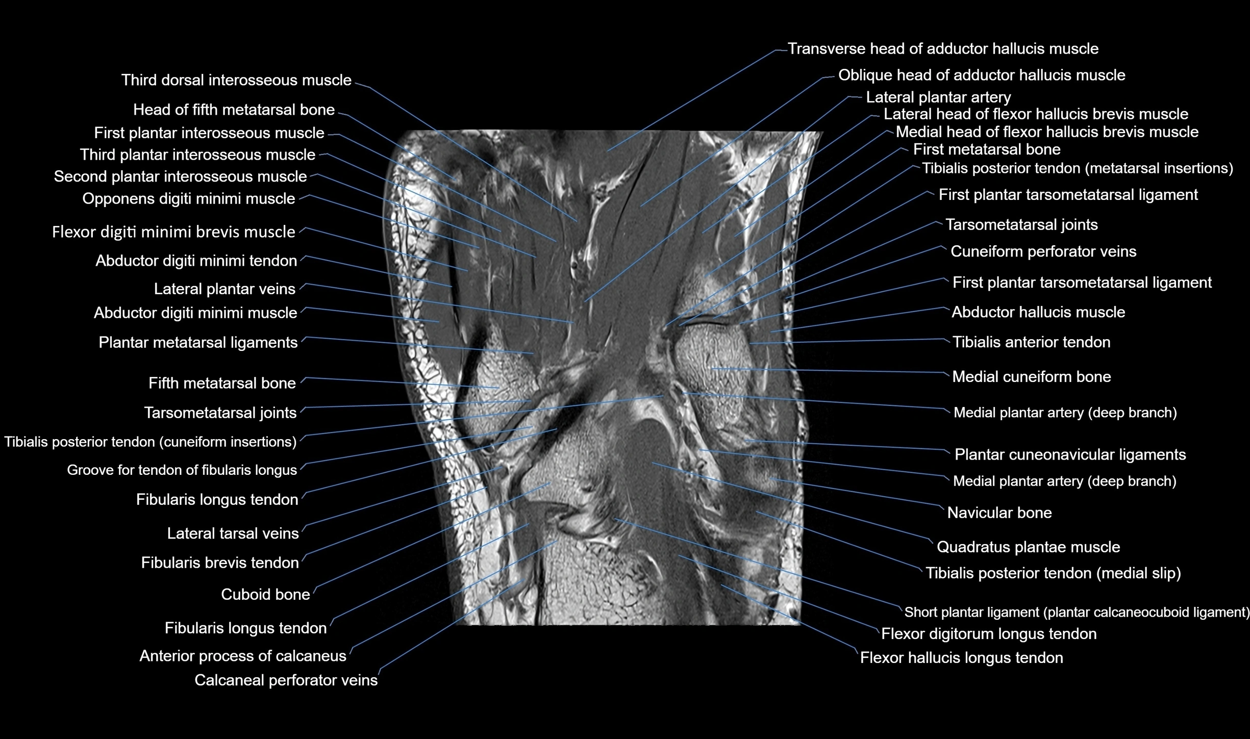 MRI mid foot coronal ligaments cross sectional anatomy 3T  radiology  image-img-00001-00028.webp
